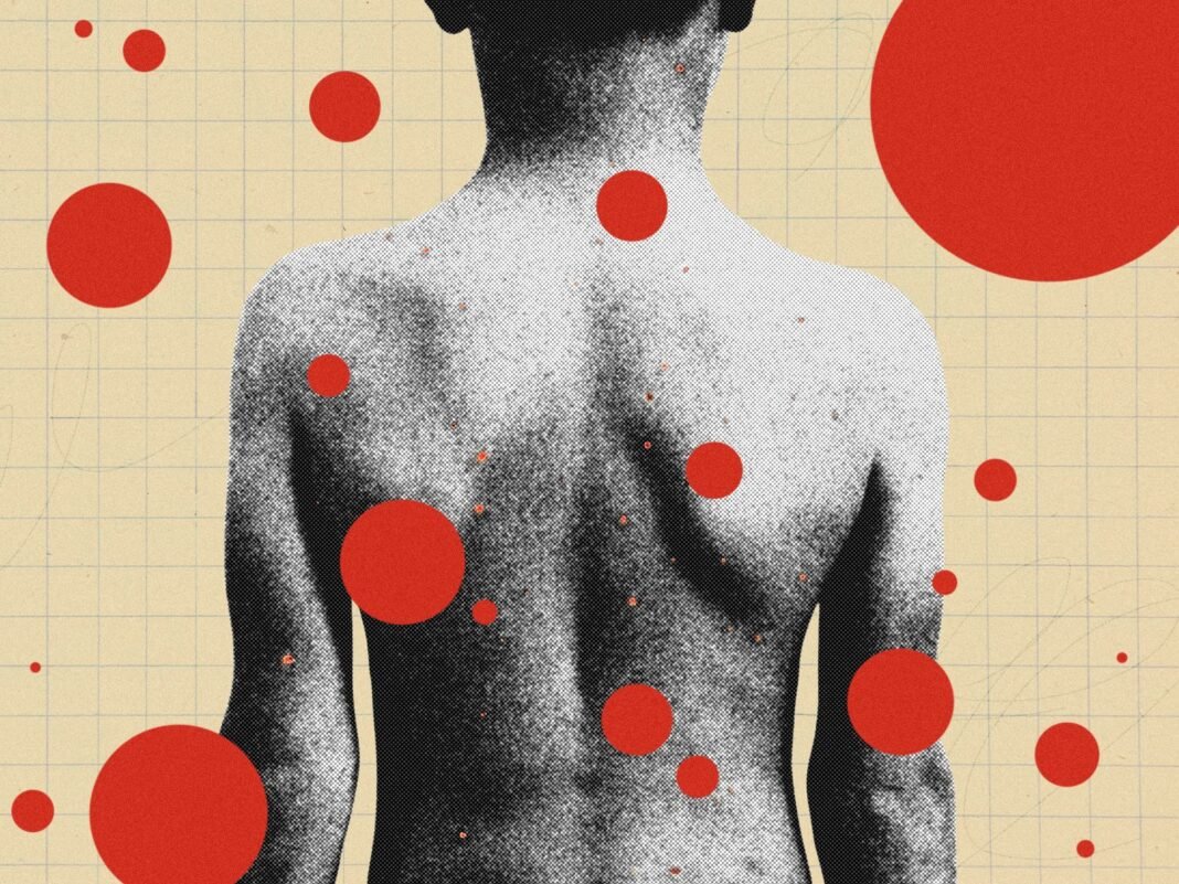 The Hidden Dangers of Chickenpox Parties: Why This Risky Trend Belongs in the Past