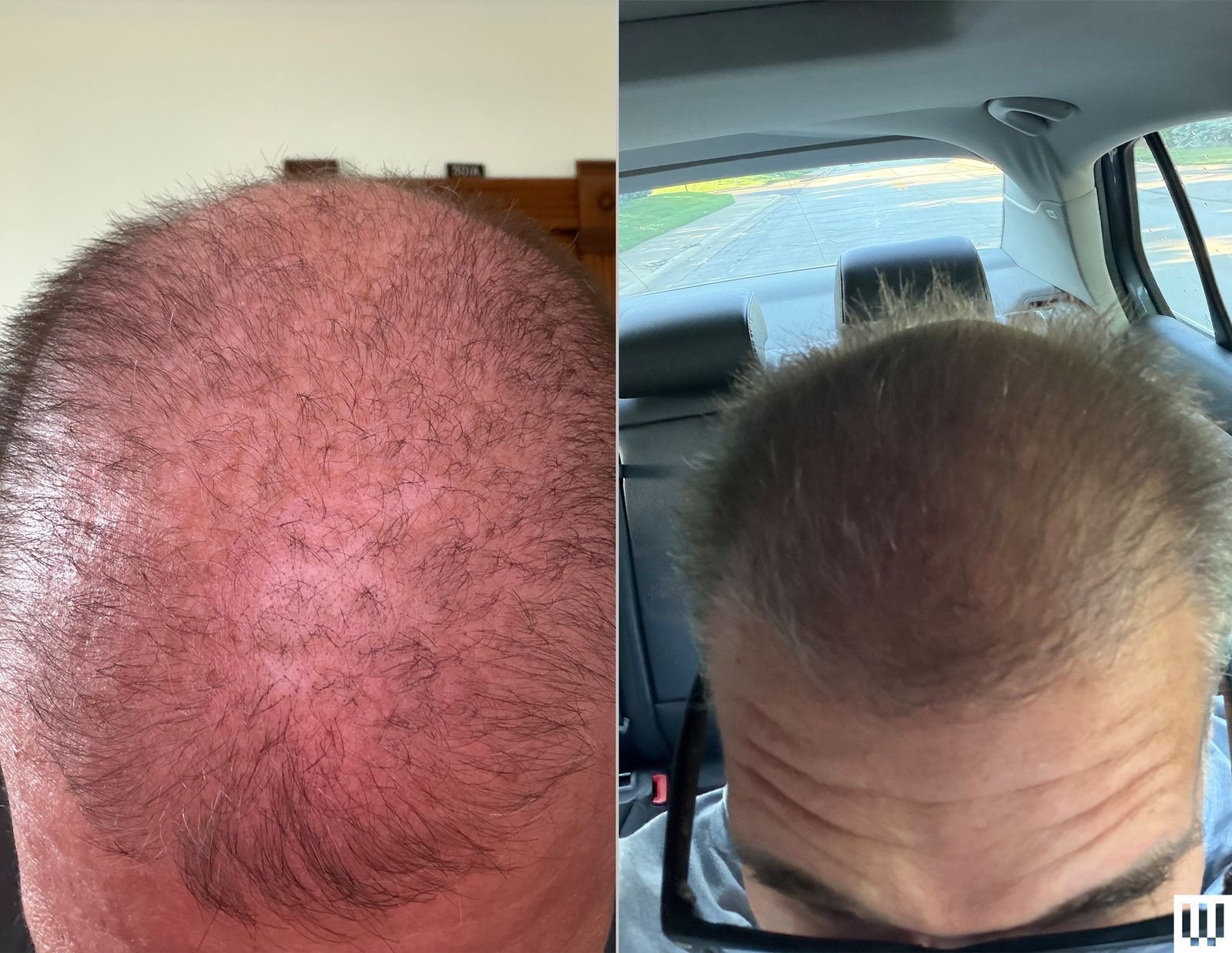 hair regrowth progress April vs June comparison
